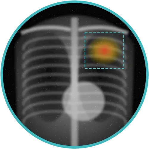 Chest X-ray with an AI TB flag